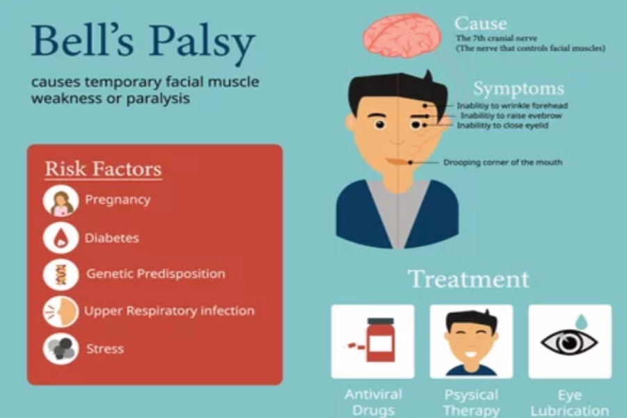 Bells Palsy Causes