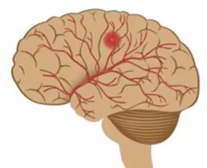 Hemorrhagic Stroke