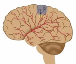 Ischemic Stroke