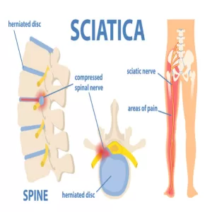 Lumbar Radiculopathy