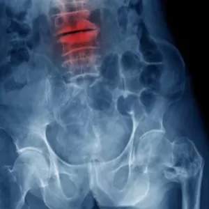 Lumbar Spondylosis