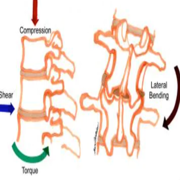 Mechanical Back Pain