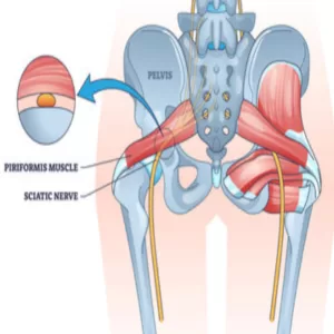 Piryformis Syndrome