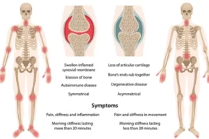 Arthritis