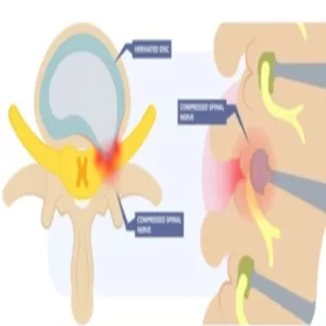 Physiotherapy For Cervical Pain