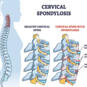 Physiotherapy For Cervical Pain