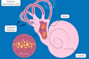 Inner Ear Dysfunctions