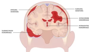 Intracranial Hemorrhages