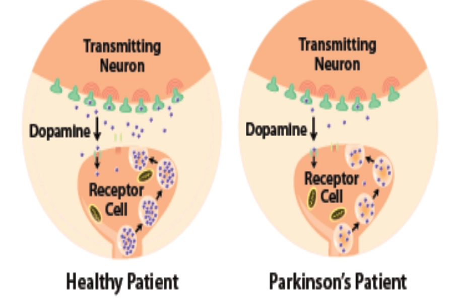 Parkinsons Disease Causes