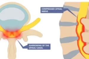 Sci Stenosis