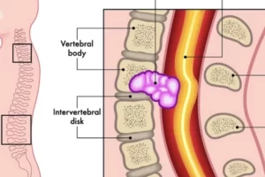 Sci Tumor