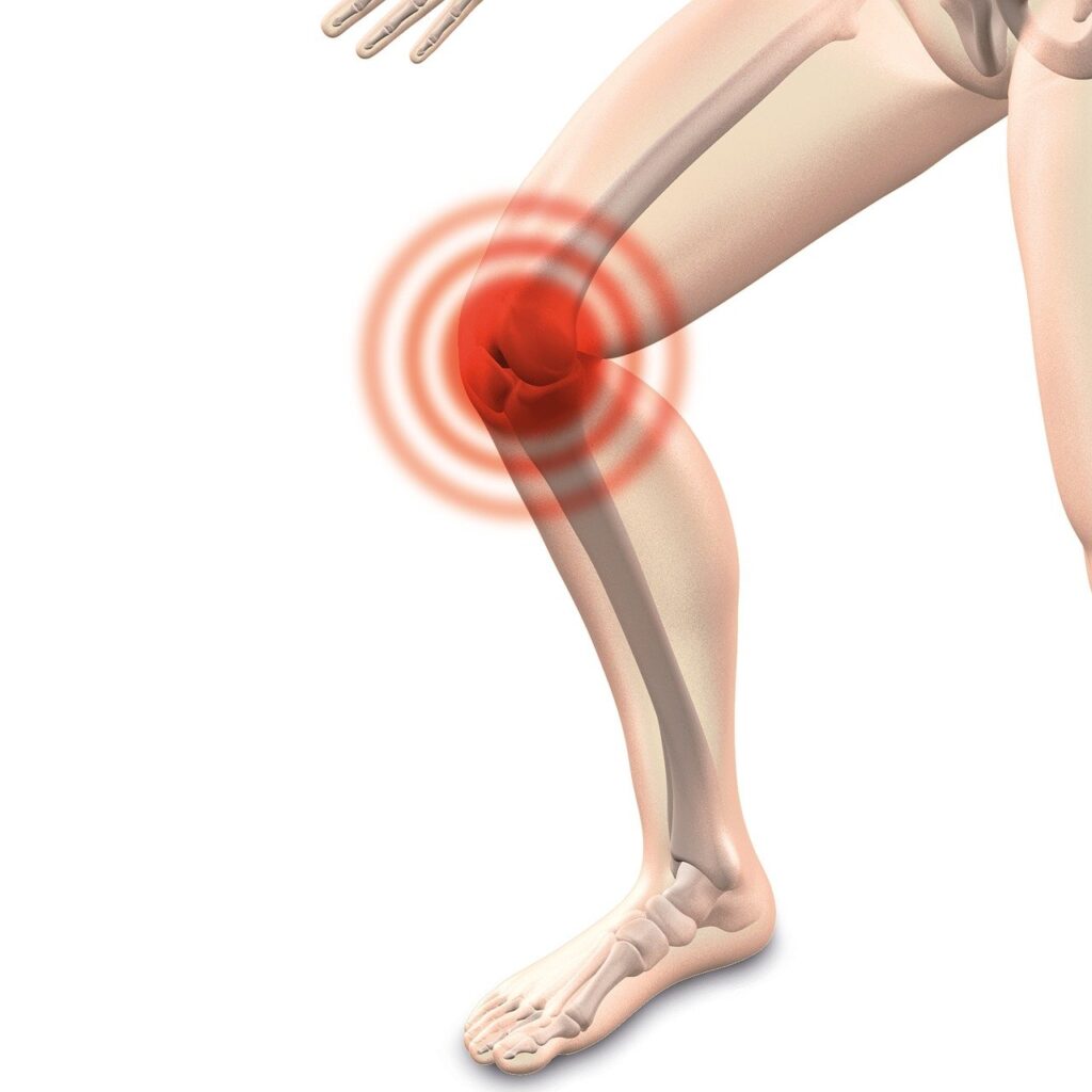 Arthrocalman, Osteoarthritis, Knee-2384253.Jpg