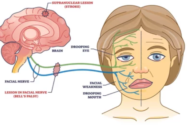 Facial Nerve