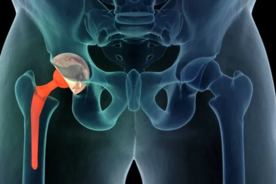 Hip Replacement Rehabilitation