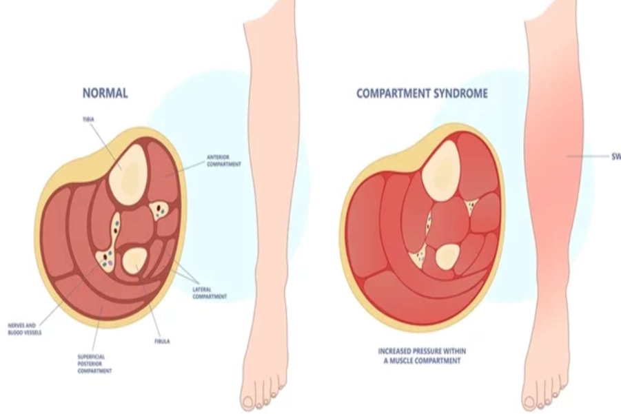 Compartment Syndrome