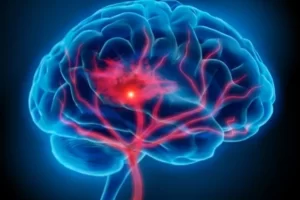 Neurological Physiotherapy For Haemorrhagic Stroke