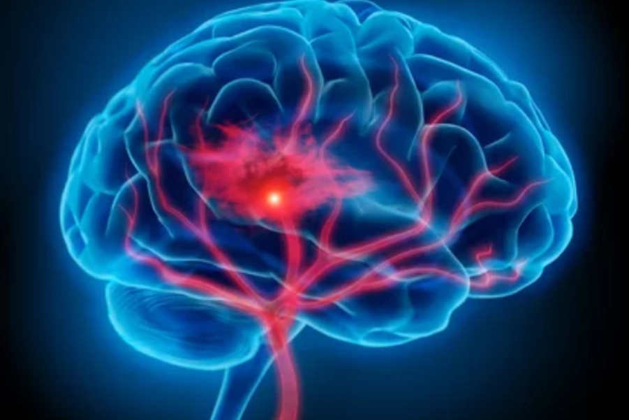 Neurological Physiotherapy For Haemorrhagic Stroke