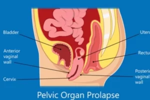 Pelvic Organ Prolapse (Pop)