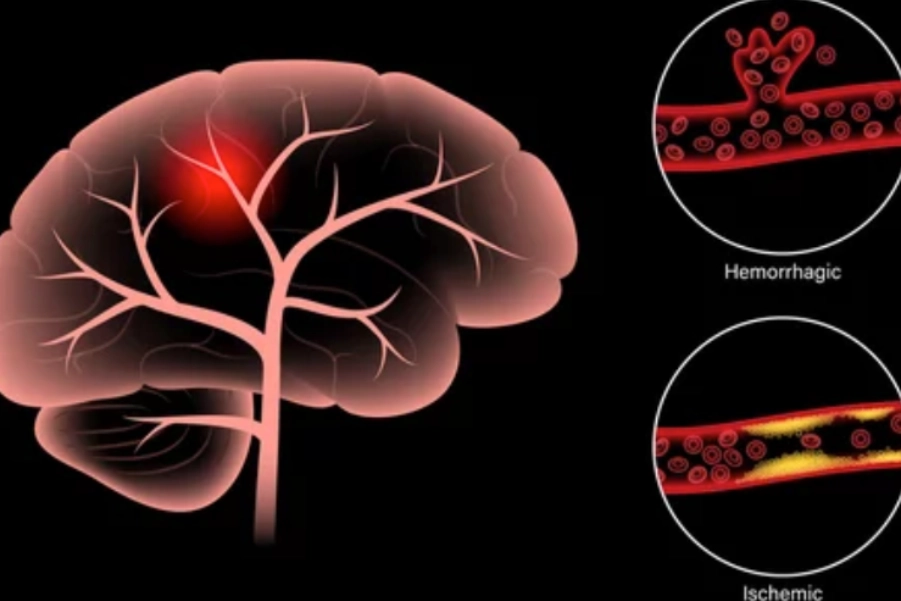 Neurological Physiotherapy For Posterior Cerebral Artery Stroke