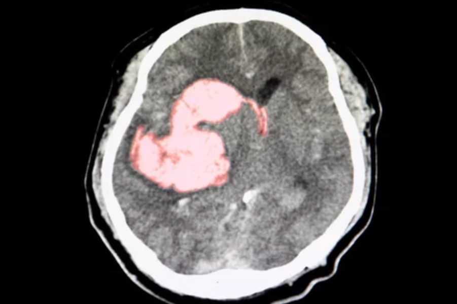 Neurological Physiotherapy For Thalamic Bleed Stroke