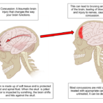 Concussion in Sports