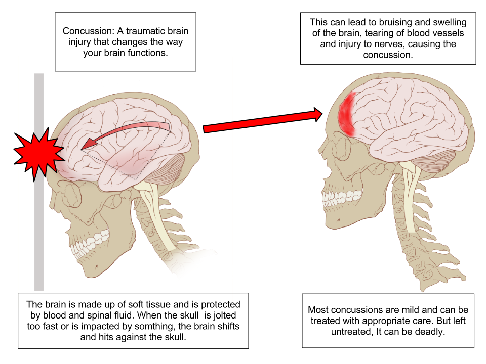 Concussion in Sports