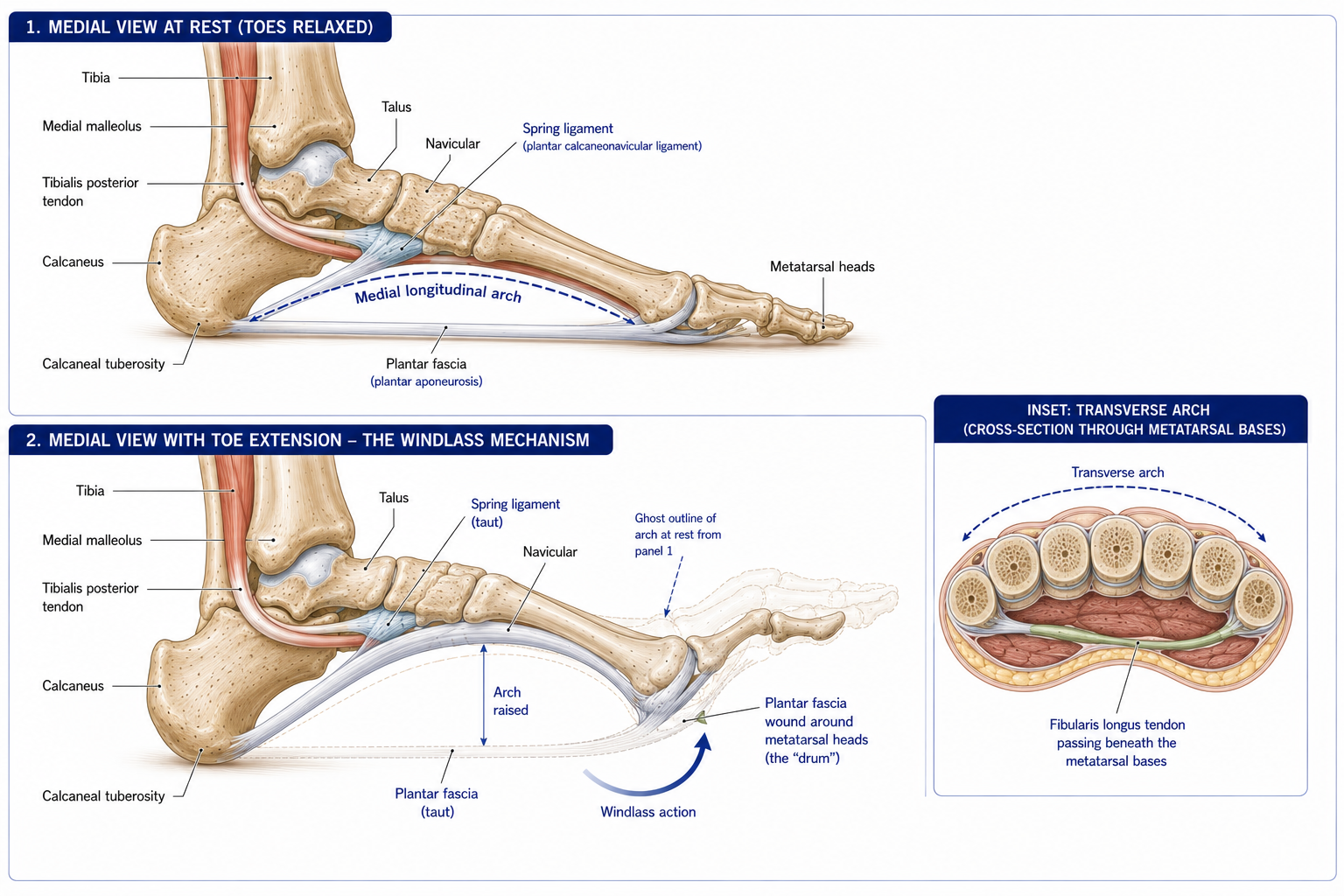 The medial arch of the foot at rest with its spring ligament, plantar fascia and tibialis posterior, beside the same foot with the toes extended, the fascia drawn taut around the metatarsal heads and the arch visibly raised, with a ghost of the resting arch behind it and an inset of the transverse arch.
