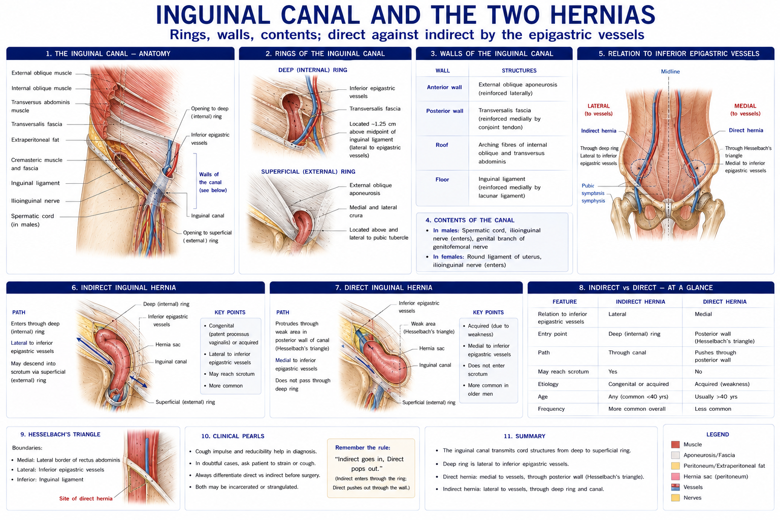 The inguinal canal with its deep and superficial rings, its four walls and its contents, and the two kinds of inguinal hernia contrasted by their relationship to the inferior epigastric vessels.