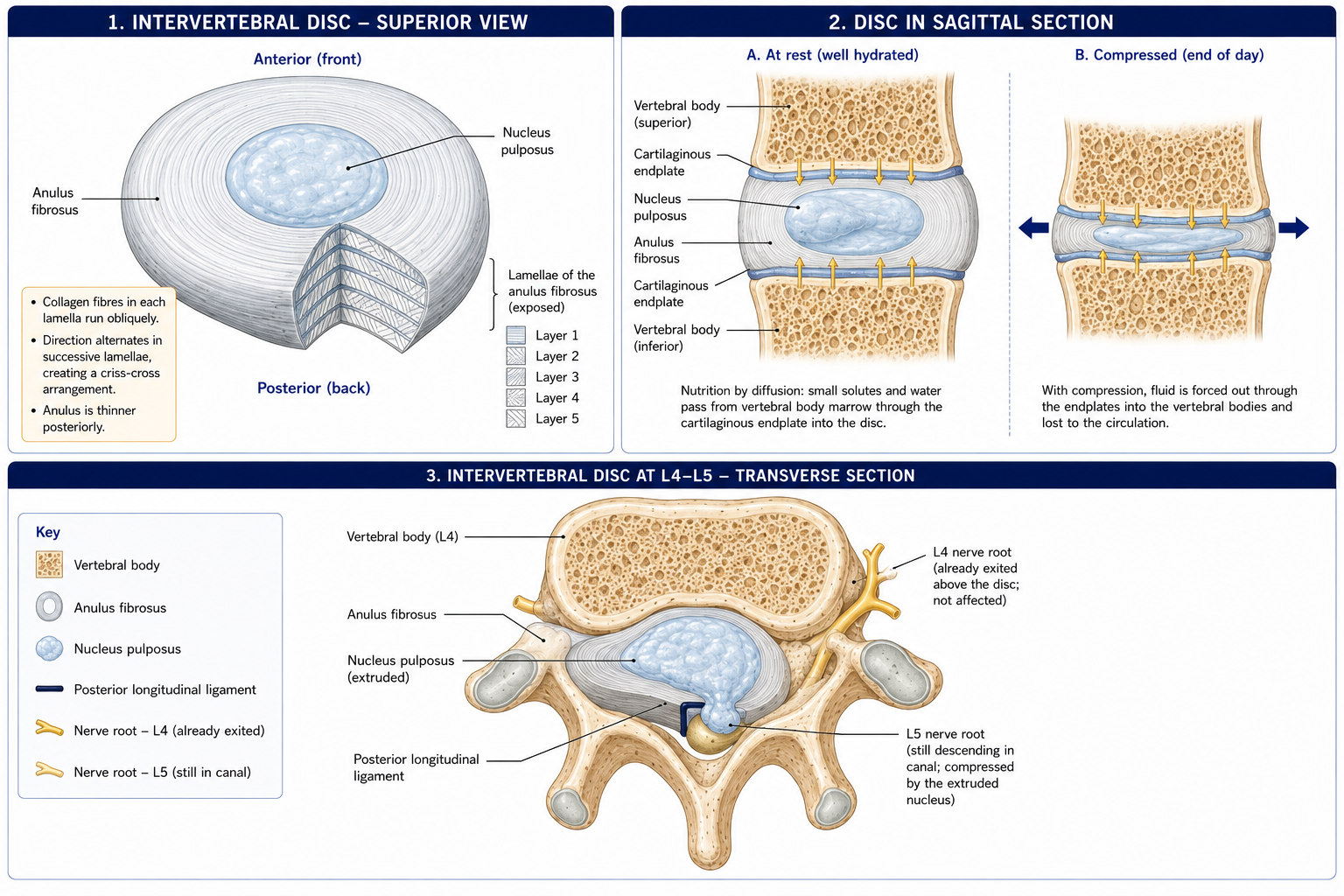 A disc from above with the anulus cut open so successive lamellae show their collagen running in alternating directions around a central nucleus, a sagittal section showing nutrition arriving by diffusion through the endplates and fluid lost under load, and a transverse view at the fourth to fifth lumbar level with a posterolateral herniation.