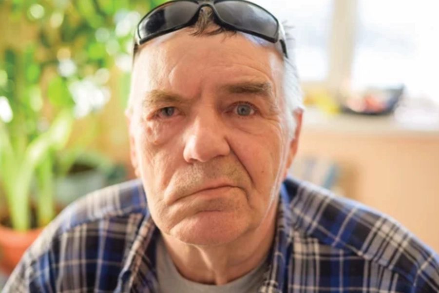 One-sided facial weakness, with loss of the normal fold and droop at the corner of the mouth.