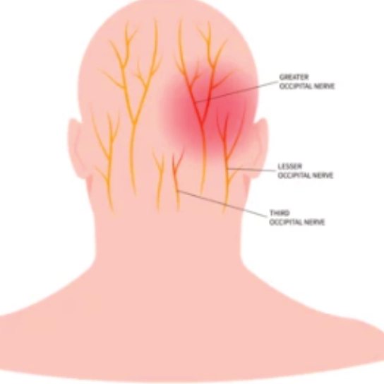 Illustration showing pain referred from the upper neck joints into the back and side of the head.