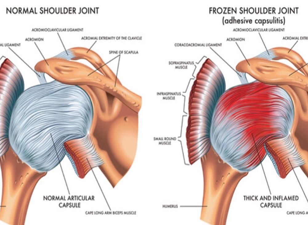 Two side-by-side anatomical illustrations of the shoulder joint. On the left, a normal shoulder joint with a pale, smooth articular capsule enclosing the head of the humerus. On the right, a frozen shoulder joint in which the same capsule is drawn thickened, contracted and inflamed red.