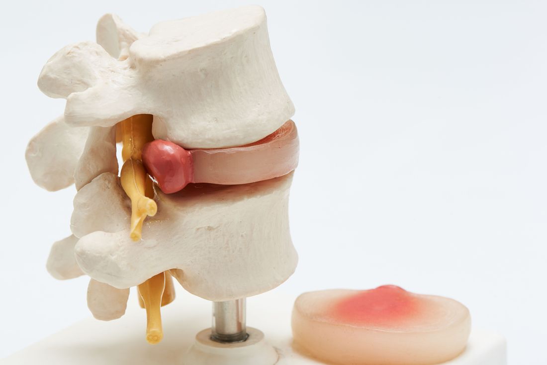 Anatomical model of two lumbar vertebrae with the intervertebral disc between them. A red bulge on the back of the disc presses toward a yellow nerve root. A separate cross-section of a disc sits beside the model.