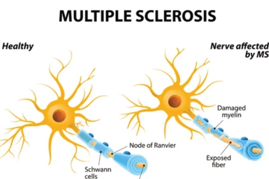 Diagram comparing a healthy nerve fibre with one whose myelin sheath has been damaged in multiple sclerosis.