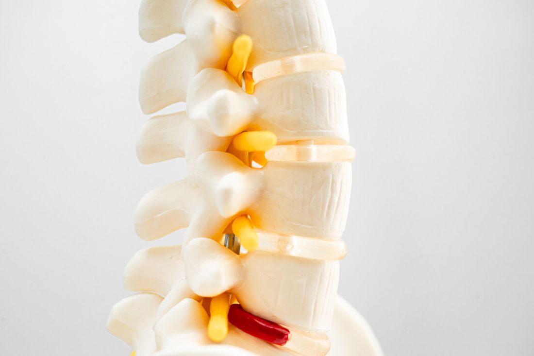 Anatomical model of lumbar vertebrae showing a displaced disc fragment positioned against a spinal nerve root as it exits the spine.